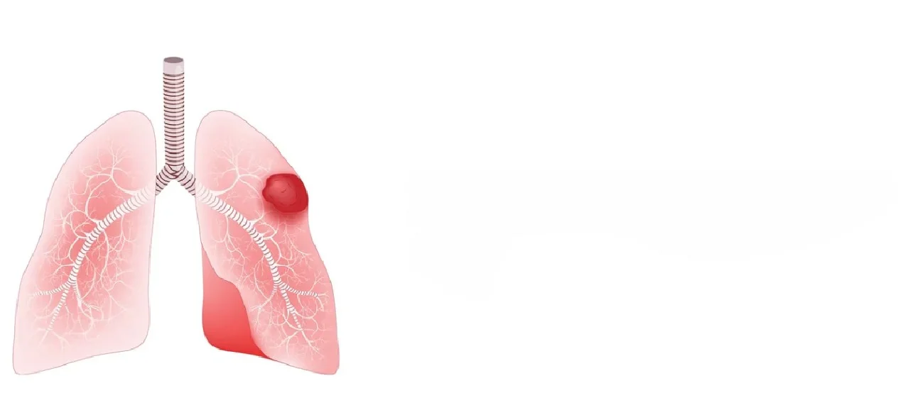 Lung Carcinoid Tumours: An easy understanding